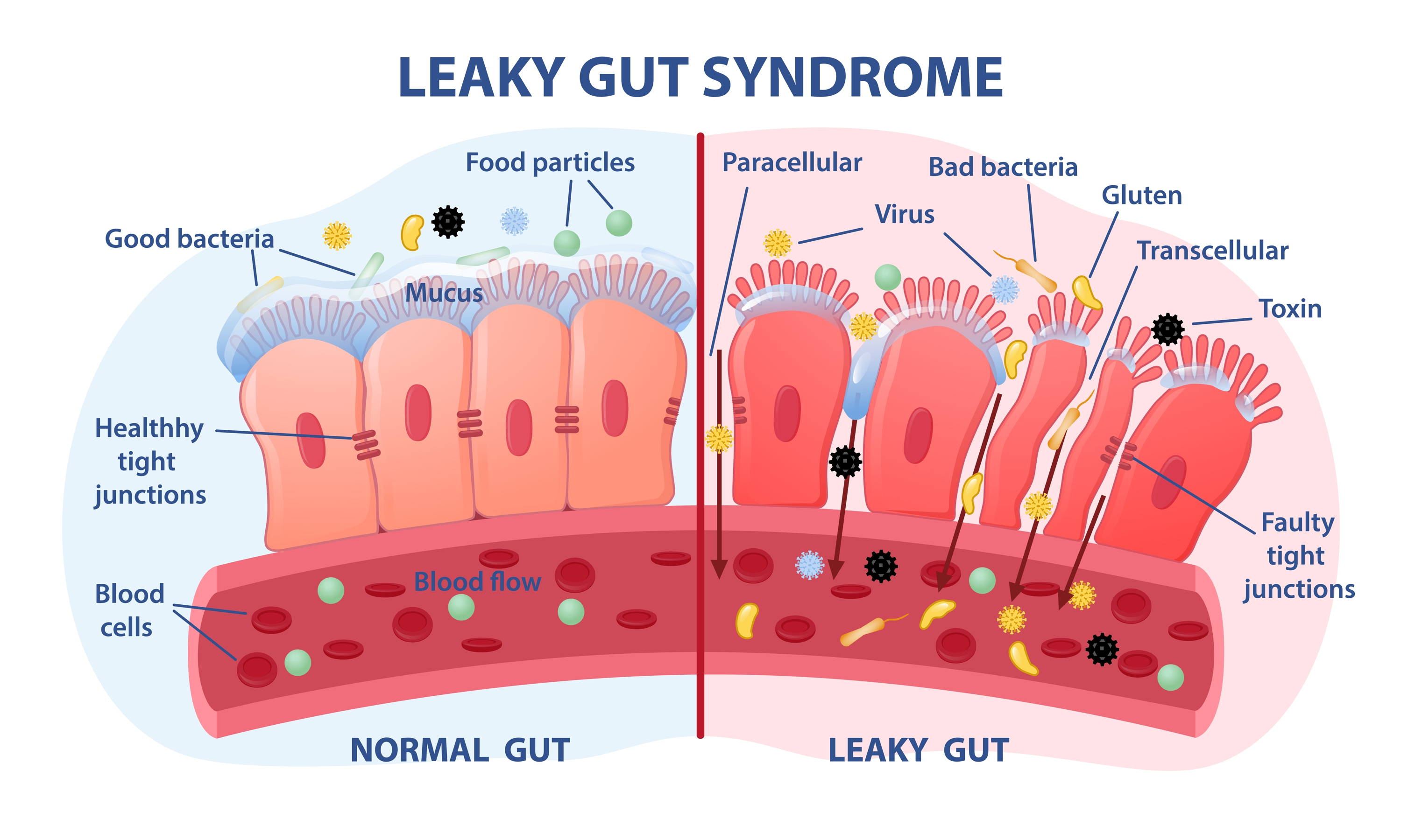 Bağırsak Geçirgenliği (Leaky Gut): Sağlam Bir Bariyerin Önemi